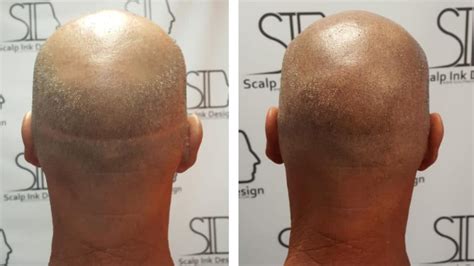 smp bugil|Scalp Micropigmentation in Miami for Hair Loss Solutions